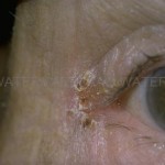 picture of blepharitis